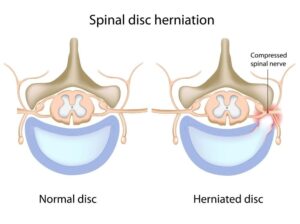 Personal Injury: Herniated Disc Injury Cases