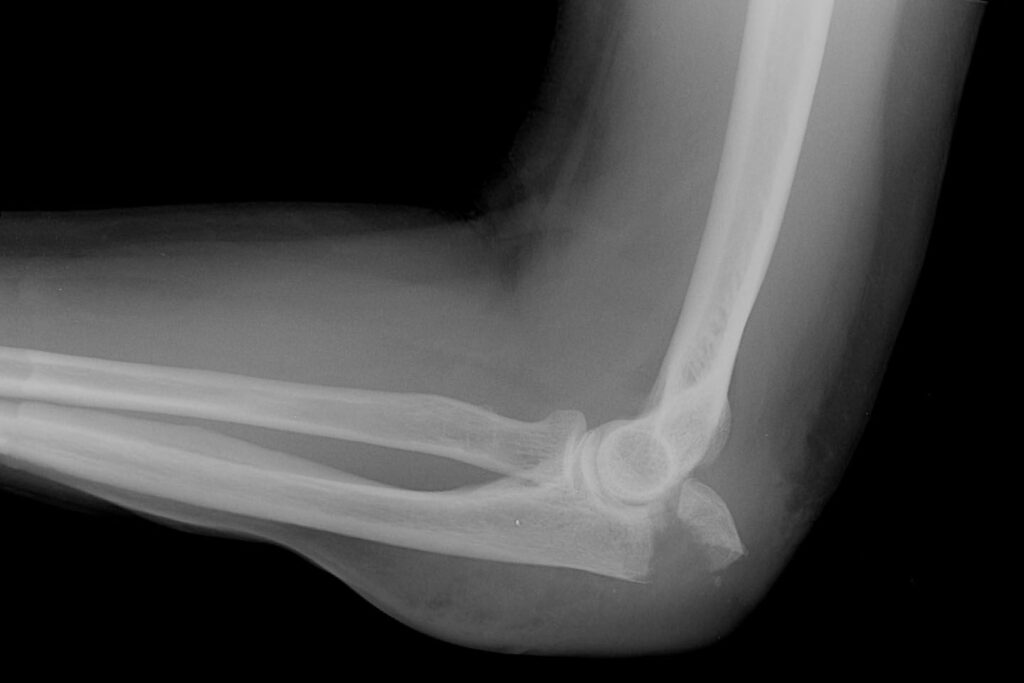 Personal Injury Cases Involving Elbow Injuries: Why You Need a Lawyer