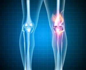 Personal Injury Cases and Knee Injuries