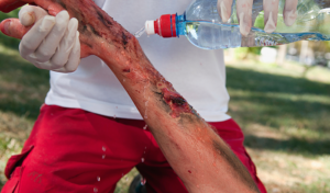 What Exactly Is A Burn Injury?