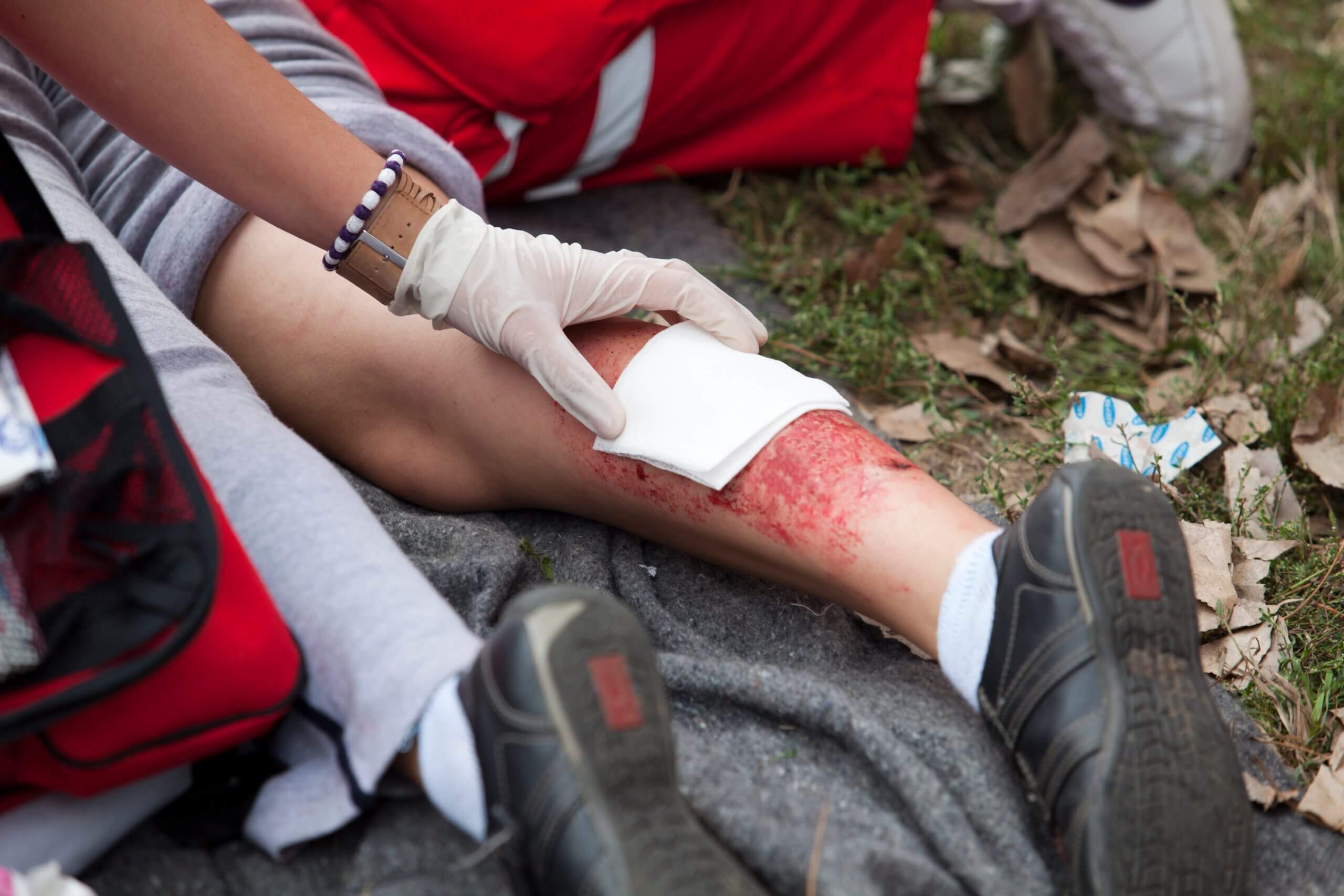 The 6 Steps To Take After You ve Suffered A Burn Injury